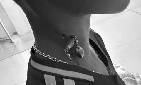 Bé trai 13 tuổi chảy máu nhiều, bác sĩ sốc khi phát hiện bí mật "đáng sợ" ở cổ