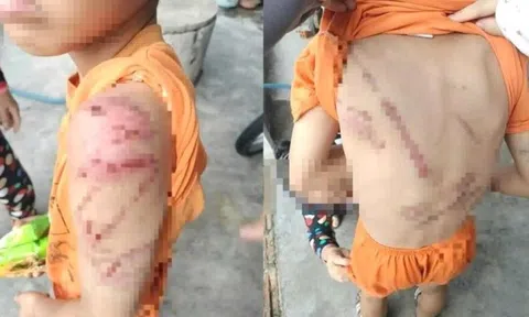 Công an vào cuộc vụ bé trai 10 tuổi chi chít vết thương