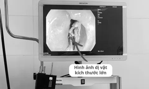 Bệnh nhân 16 tuổi đau họng kéo dài, bác sĩ phát biện bí mật "đáng sợ" bên trong