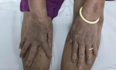 Tin vào thuốc lạ “uống thấy khỏe”, cụ ông 87 tuổi nhập viện trong tình trạng nguy kịch