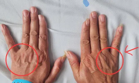 Tê ngón tay út tưởng chuyện nhỏ, người đàn ông 51 tuổi suýt bị teo cả bàn tay