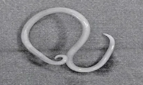 Thiếu niên 15 tuổi bị đau bụng thúc ngược lên, bác sĩ phát hiện "bí mật" đáng sợ bên trong