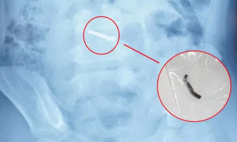 Bé trai thủng ruột vì nuốt nhiều nam châm trong đồ chơi