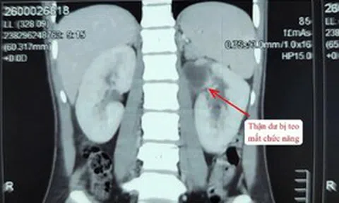 Kỳ lạ cô gái 22 tuổi có 3 quả thận