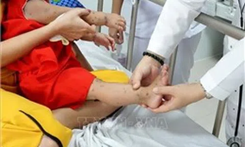 Tây Ninh: Bệnh tay chân miệng tăng 2,5 lần