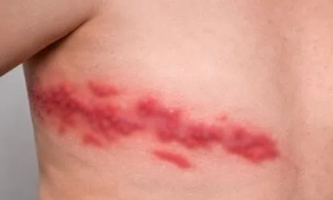 Cảnh báo nguy cơ gia tăng bệnh zona ở người có bệnh mạn tính