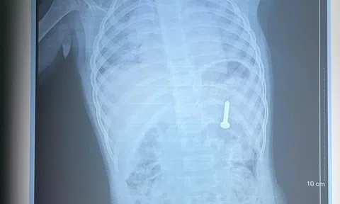 Đang chơi ở nhà, bé gần 2 tuổi nuốt phải thứ "đáng sợ"