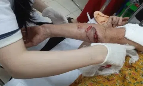 Chó lạ hung hãn tấn công 3 phụ nữ đi tập thể dục