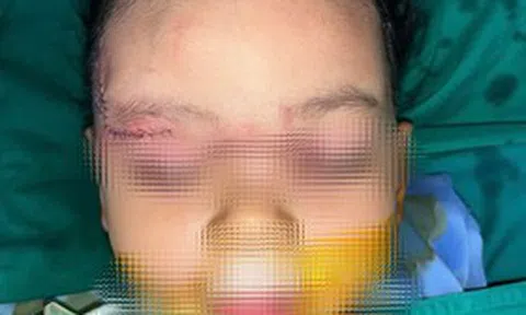 Bé 22 tháng tuổi bị chó cắn: Bác sĩ xử trí nhanh, hạn chế biến chứng