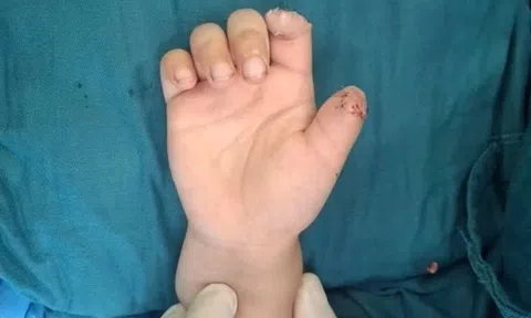 Bé 5 tuổi đứt hai ngón tay vì chơi xe điện tự chế