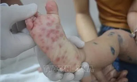 Trường học chủ động phòng, chống bệnh tay chân miệng