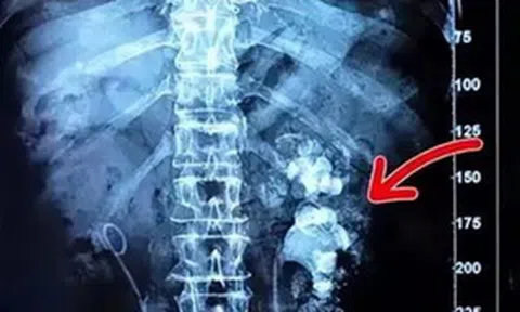 Cô gái trẻ nhập viện, bác sĩ phát hiện hai bên thận chi chít sỏi vì món đồ uống yêu thích