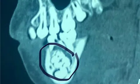 Đau hàm kéo dài, bé trai "sốc" vì gần 50 chiếc răng trong miệng