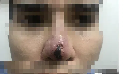 Hoại tử mông, vỡ mũi vì tiêm chất làm đầy trôi nổi không rõ nguồn gốc