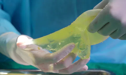 Phẫu thuật khẩn cấp cho bệnh nhân nữ bị vỡ túi ngực