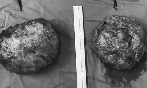 Làm đẹp tại cơ sở kém chất lượng, một phụ nữ bị vỡ túi độn ngực, phải nhập viện