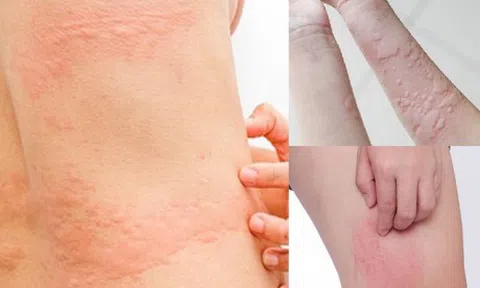 Bỏ túi 5 cách trị dị ứng mề đay do thay đổi thời tiết